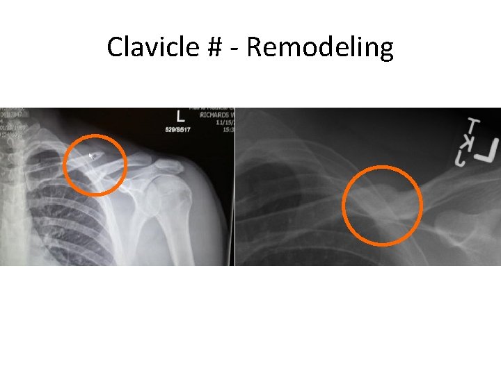 Clavicle # - Remodeling 