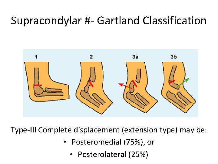 Supracondylar #- Gartland Classification Type-III Complete displacement (extension type) may be: • Posteromedial (75%),