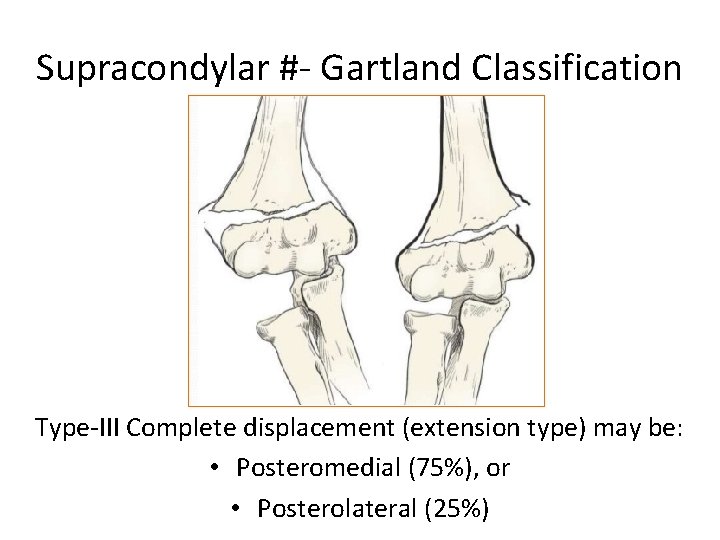 Supracondylar #- Gartland Classification Type-III Complete displacement (extension type) may be: • Posteromedial (75%),