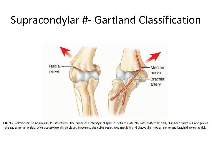 Supracondylar #- Gartland Classification 