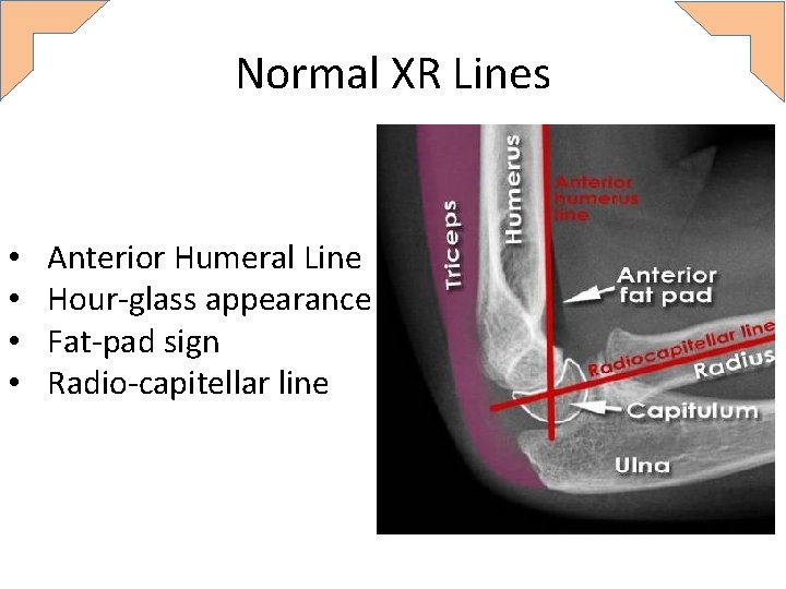 Normal XR Lines • • Anterior Humeral Line Hour-glass appearance Fat-pad sign Radio-capitellar line