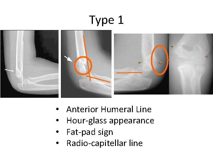 Type 1 • • Anterior Humeral Line Hour-glass appearance Fat-pad sign Radio-capitellar line 