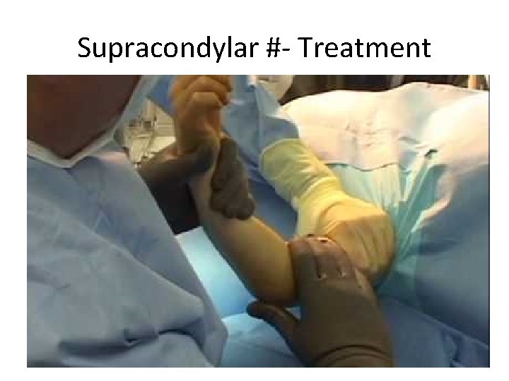 Supracondylar #- Treatment 