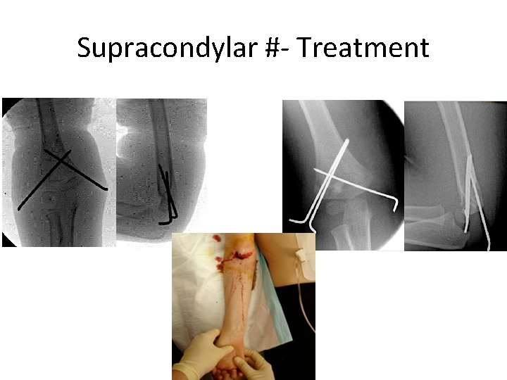 Supracondylar #- Treatment 