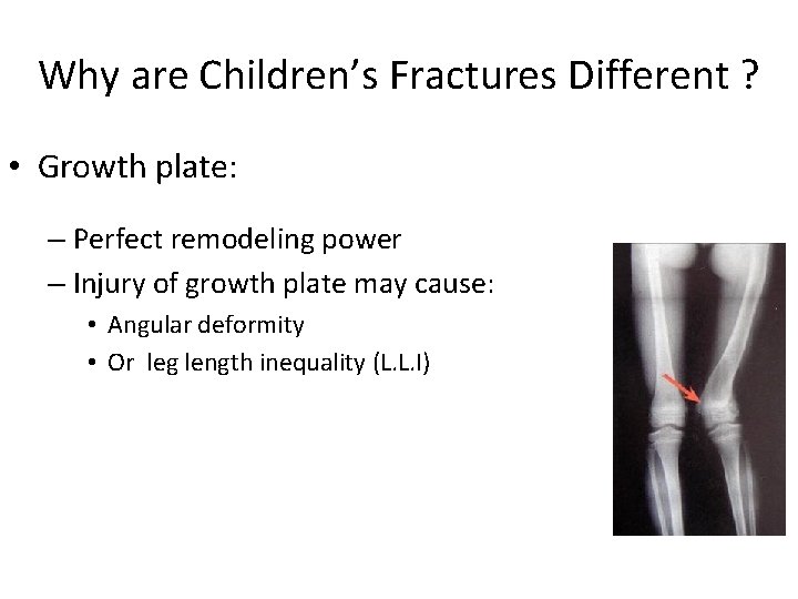 Why are Children’s Fractures Different ? • Growth plate: – Perfect remodeling power –