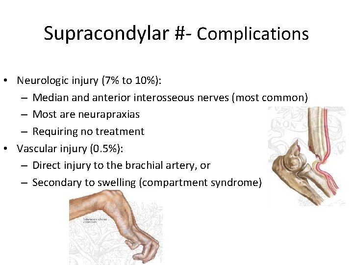 Supracondylar #- Complications • Neurologic injury (7% to 10%): – Median and anterior interosseous