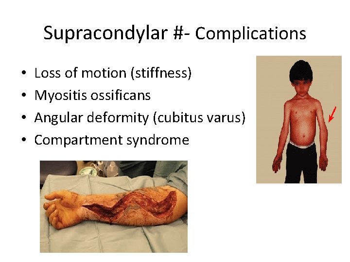 Supracondylar #- Complications • • Loss of motion (stiffness) Myositis ossificans Angular deformity (cubitus