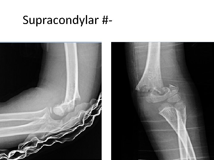 Supracondylar #- Flexion Type 3 