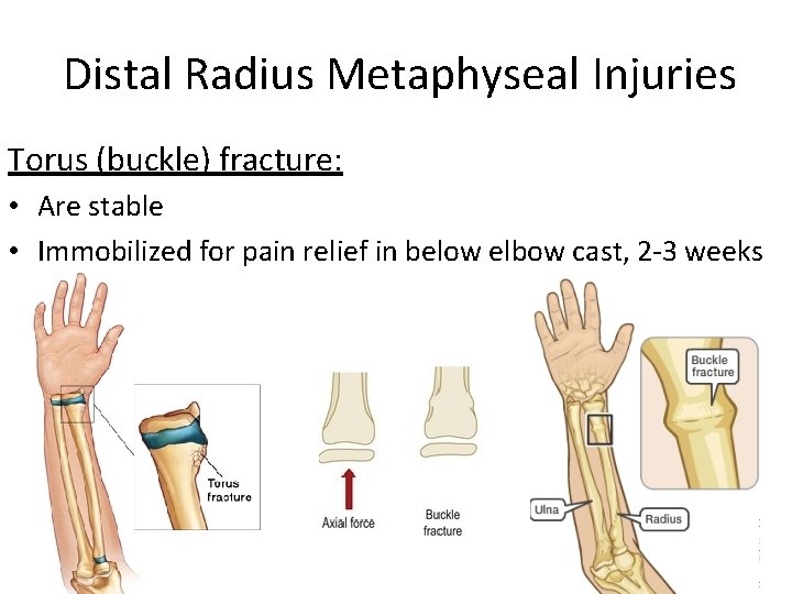 Distal Radius Metaphyseal Injuries Torus (buckle) fracture: • Are stable • Immobilized for pain