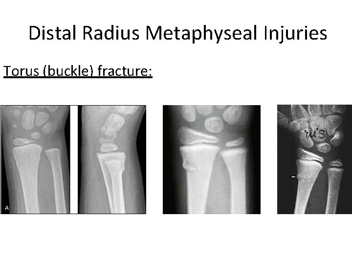Distal Radius Metaphyseal Injuries Torus (buckle) fracture: 