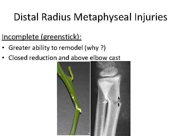 Distal Radius Metaphyseal Injuries Incomplete (greenstick): • Greater ability to remodel (why ? )