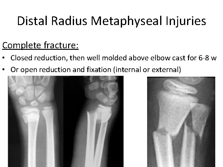 Distal Radius Metaphyseal Injuries Complete fracture: • Closed reduction, then well molded above elbow