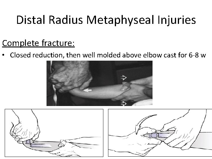 Distal Radius Metaphyseal Injuries Complete fracture: • Closed reduction, then well molded above elbow
