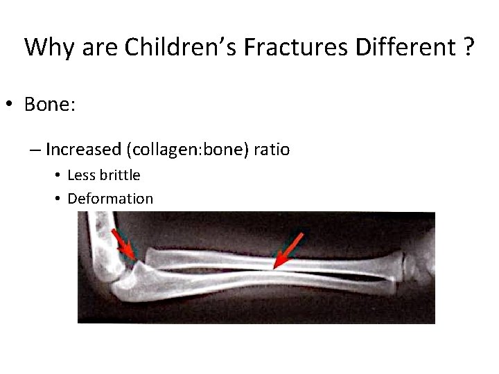 Why are Children’s Fractures Different ? • Bone: – Increased (collagen: bone) ratio •