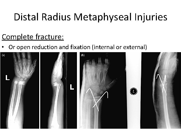 Distal Radius Metaphyseal Injuries Complete fracture: • Or open reduction and fixation (internal or