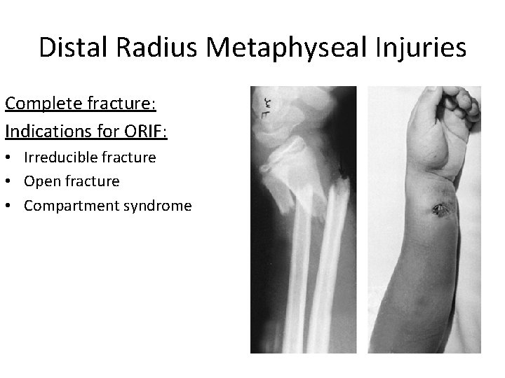 Distal Radius Metaphyseal Injuries Complete fracture: Indications for ORIF: • Irreducible fracture • Open