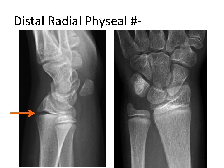 Distal Radial Physeal #- “S. H” Type I 