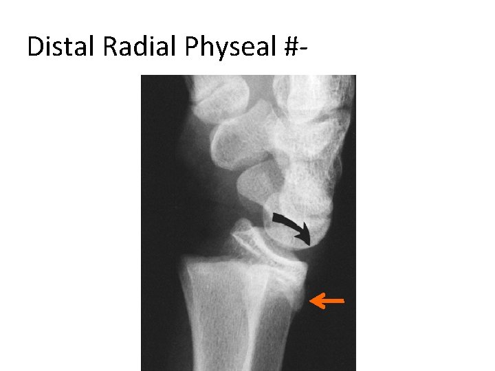 Distal Radial Physeal #- “S. H” Type II 