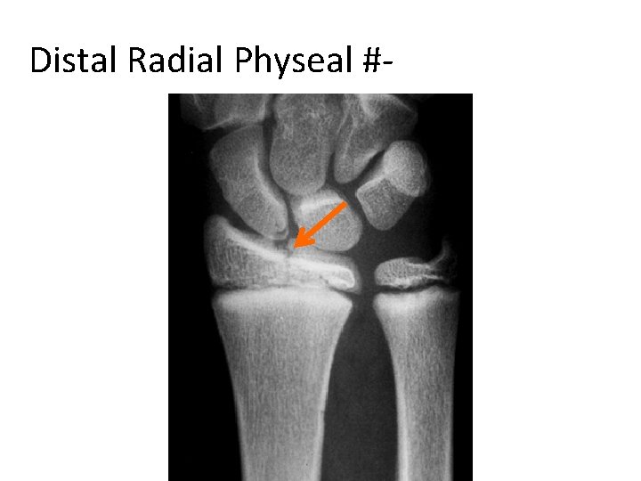 Distal Radial Physeal #- “S. H” Type III 
