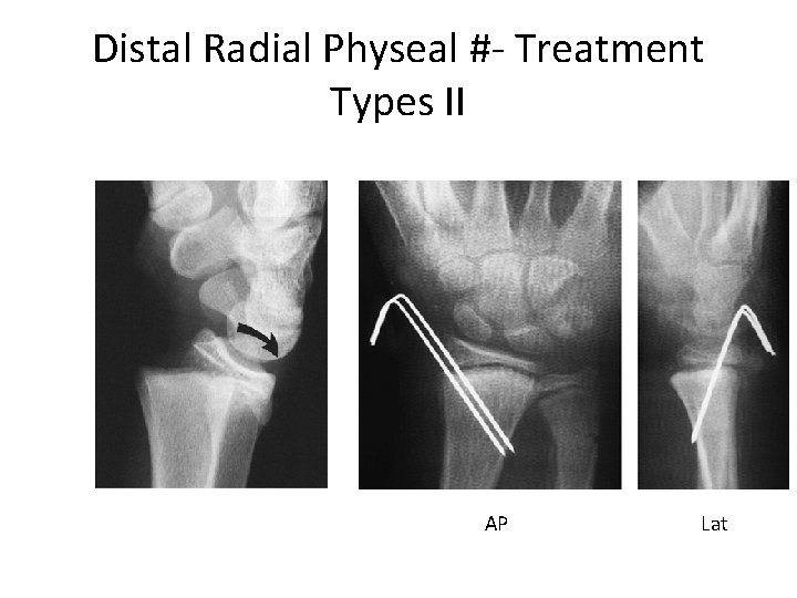 Distal Radial Physeal #- Treatment Types II AP Lat 