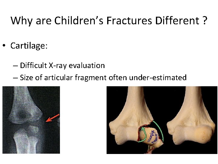 Why are Children’s Fractures Different ? • Cartilage: – Difficult X-ray evaluation – Size