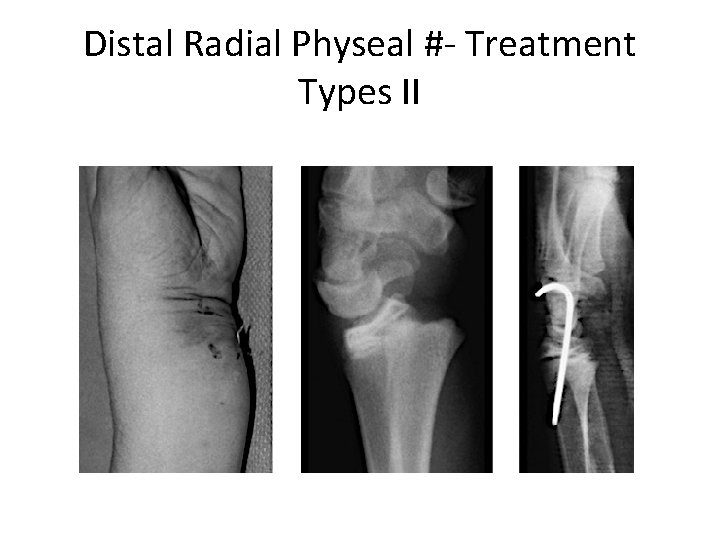 Distal Radial Physeal #- Treatment Types II 