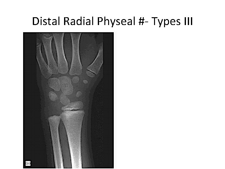 Distal Radial Physeal #- Types III 