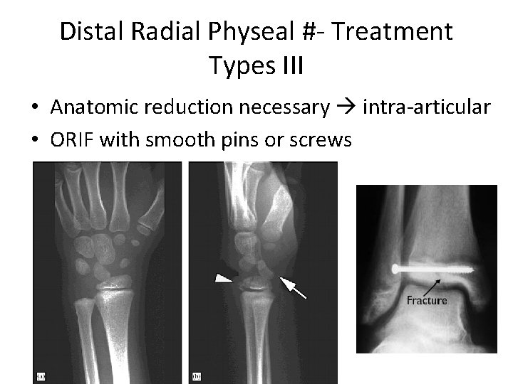 Distal Radial Physeal #- Treatment Types III • Anatomic reduction necessary intra-articular • ORIF