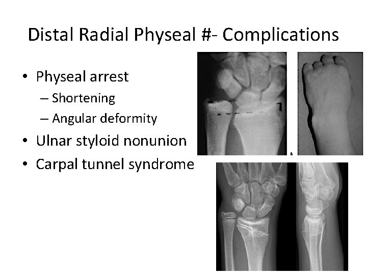 Distal Radial Physeal #- Complications • Physeal arrest – Shortening – Angular deformity •