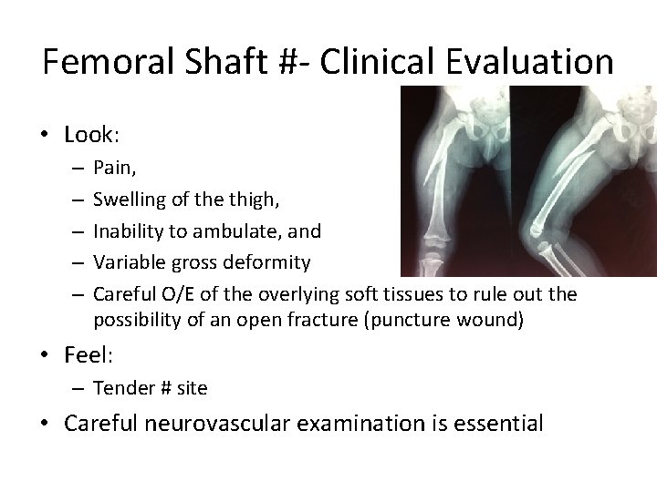 Femoral Shaft #- Clinical Evaluation • Look: – – – Pain, Swelling of the
