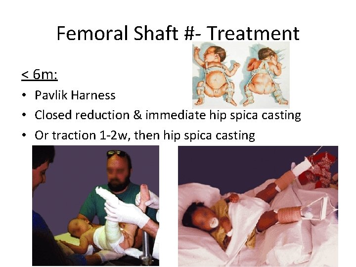Femoral Shaft #- Treatment < 6 m: • Pavlik Harness • Closed reduction &