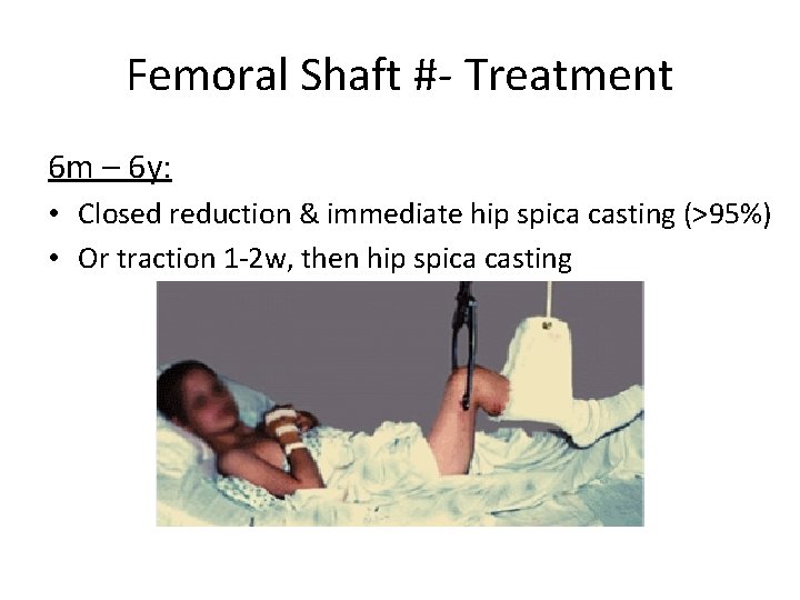 Femoral Shaft #- Treatment 6 m – 6 y: • Closed reduction & immediate