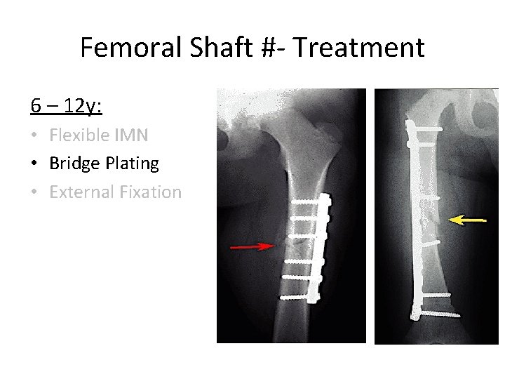 Femoral Shaft #- Treatment 6 – 12 y: • Flexible IMN • Bridge Plating