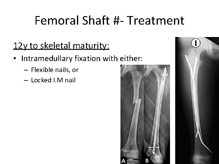 Femoral Shaft #- Treatment 12 y to skeletal maturity: • Intramedullary fixation with either: