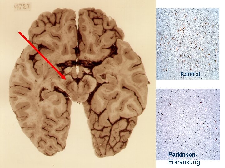 Kontrol Parkinson. Erkrankung 