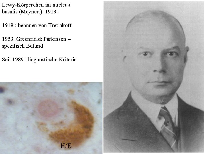 Lewy-Körperchen im nucleus basalis (Meynert): 1913. 1919 : bennnen von Tretiakoff 1953. Greenfield: Parkinson