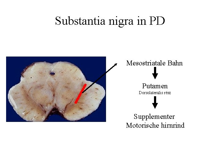 Substantia nigra in PD Mesostriatale Bahn Putamen Dorsolateralis rész Supplementer Motorische hirnrind 