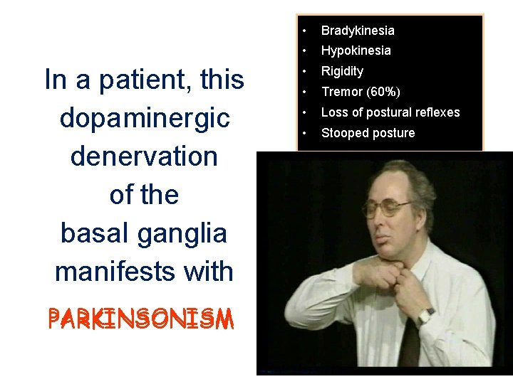 In a patient, this dopaminergic denervation of the basal ganglia manifests with PARKINSONISM •