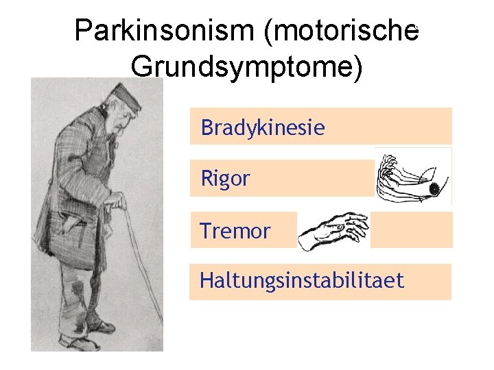 Parkinson’s disease Parkinsonism (motorische Symptoms Grundsymptome) Bradykinesie Rigor Tremor Haltungsinstabilitaet 22 