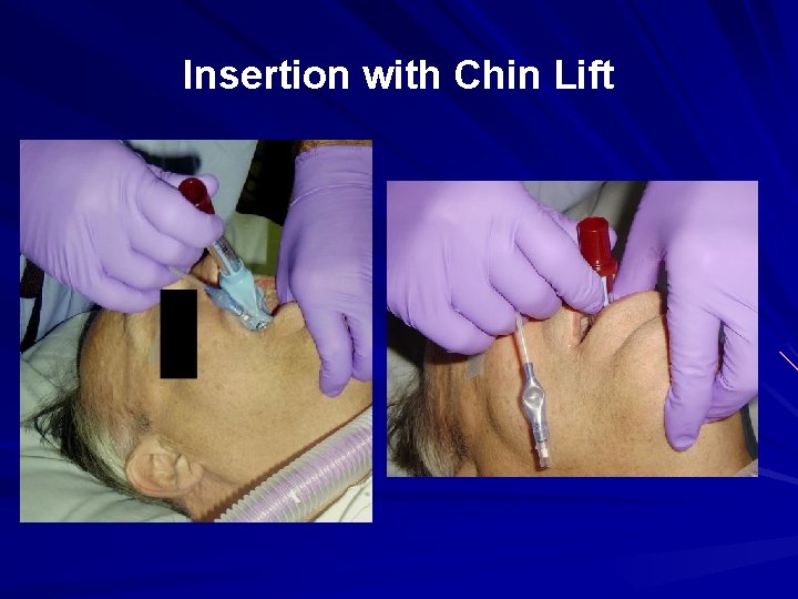 Insertion with Chin Lift 