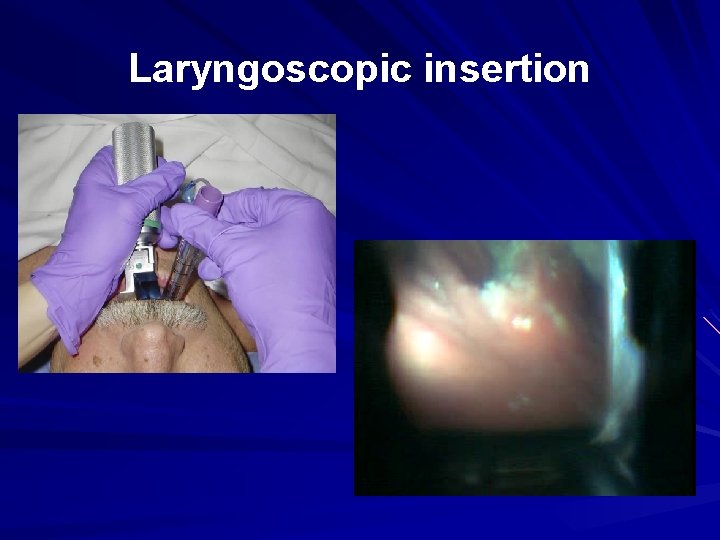 Laryngoscopic insertion 