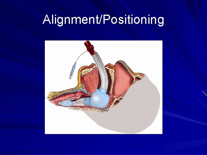 Alignment/Positioning 