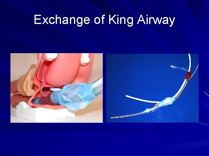 Exchange of King Airway 