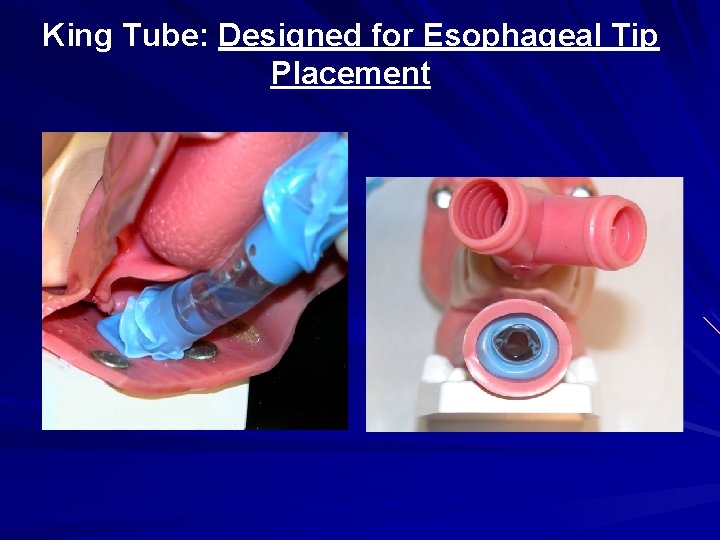 King Tube: Designed for Esophageal Tip Placement 