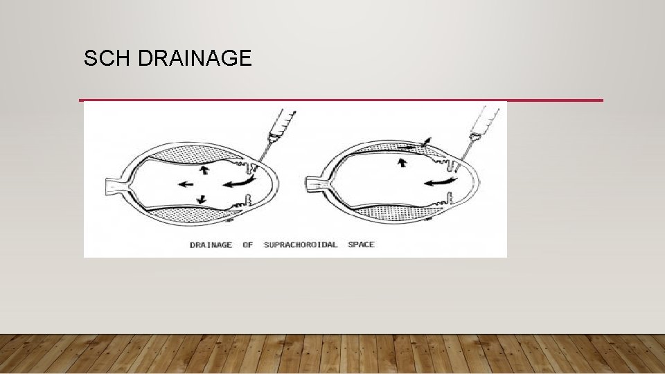 SCH DRAINAGE suprachoroidal space. After the posterior sclerostomies are ated. 