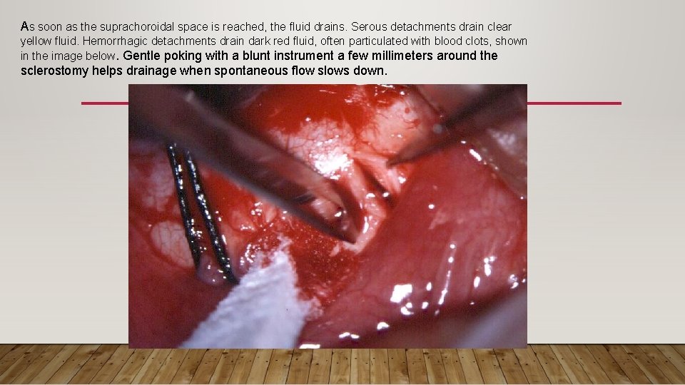 As soon as the suprachoroidal space is reached, the fluid drains. Serous detachments drain