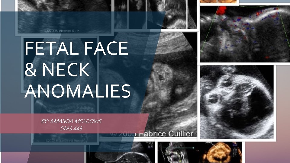 FETAL FACE & NECK ANOMALIES BY: AMANDA MEADOWS DMS 443 