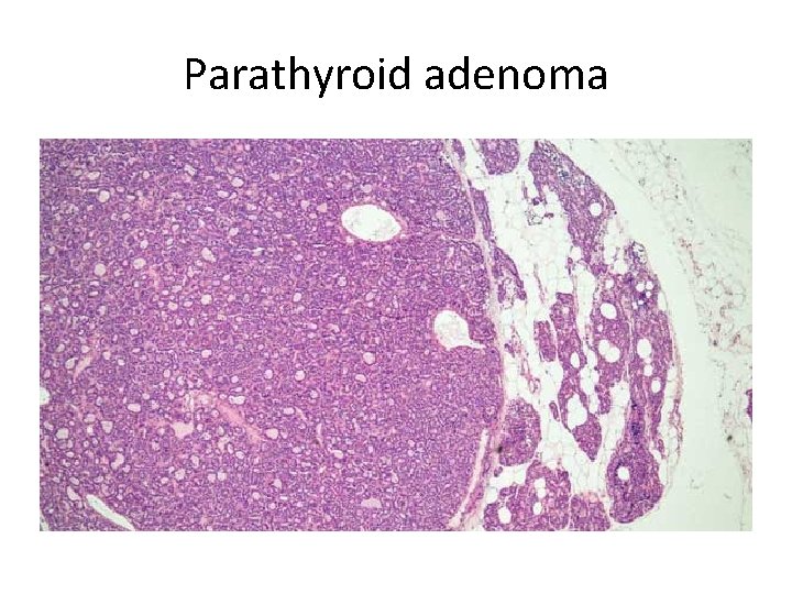 Parathyroid adenoma 