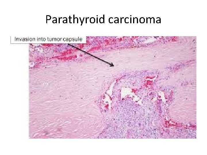 Parathyroid carcinoma 