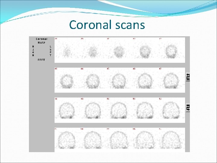 Coronal scans 